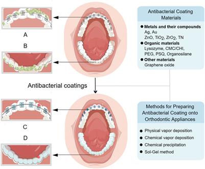 Recent advances in antibacterial coatings for orthodontic appliances